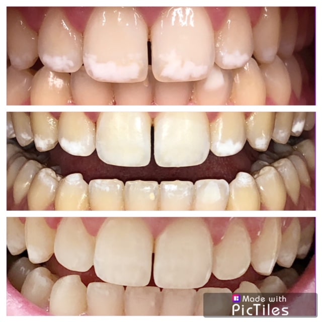 Before and After Images of Icon white spot removal Annandale NJ
