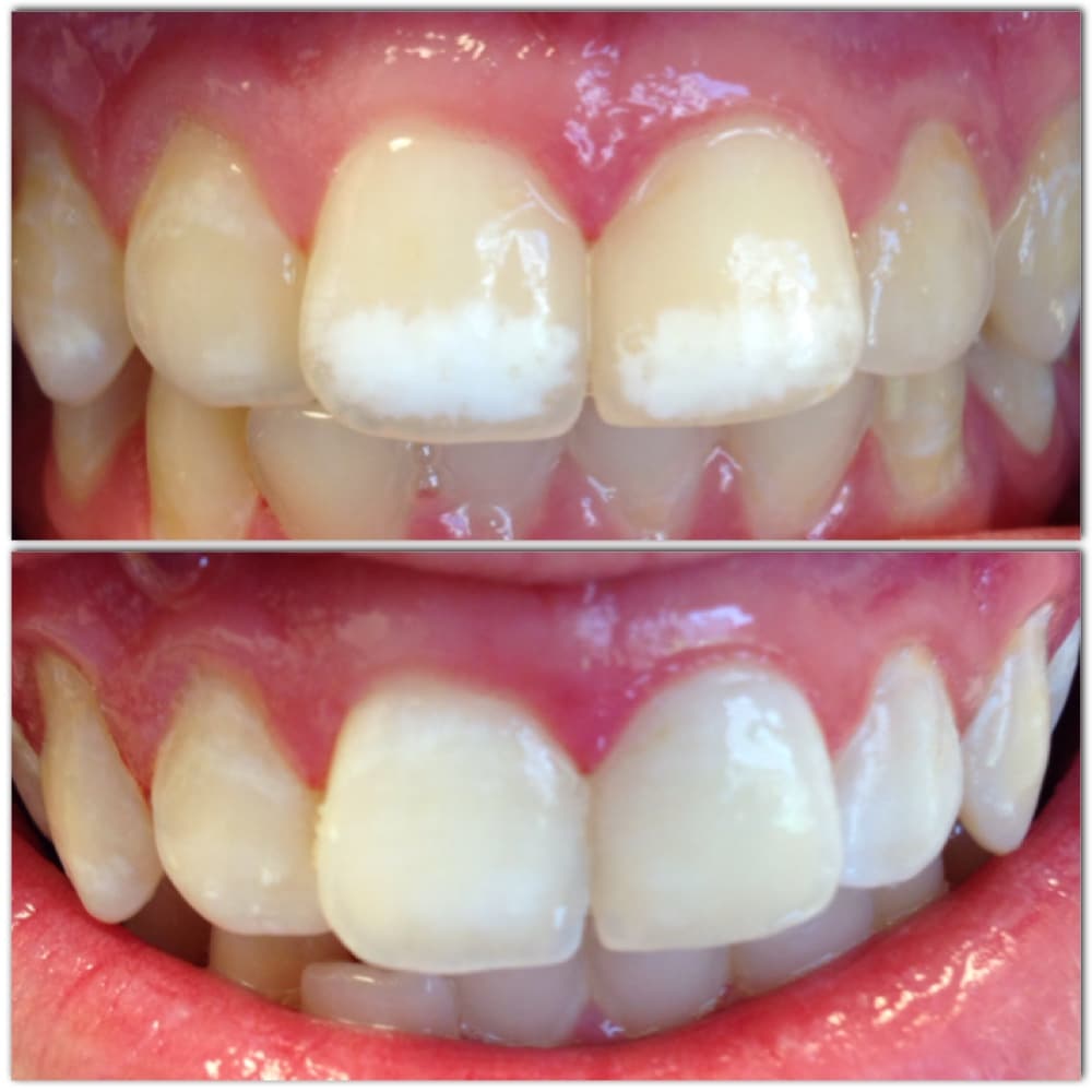 ICON White Spot Removal Procedure Annandale NJ