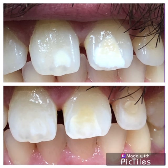 ICON White Spot Removal Annandale NJ