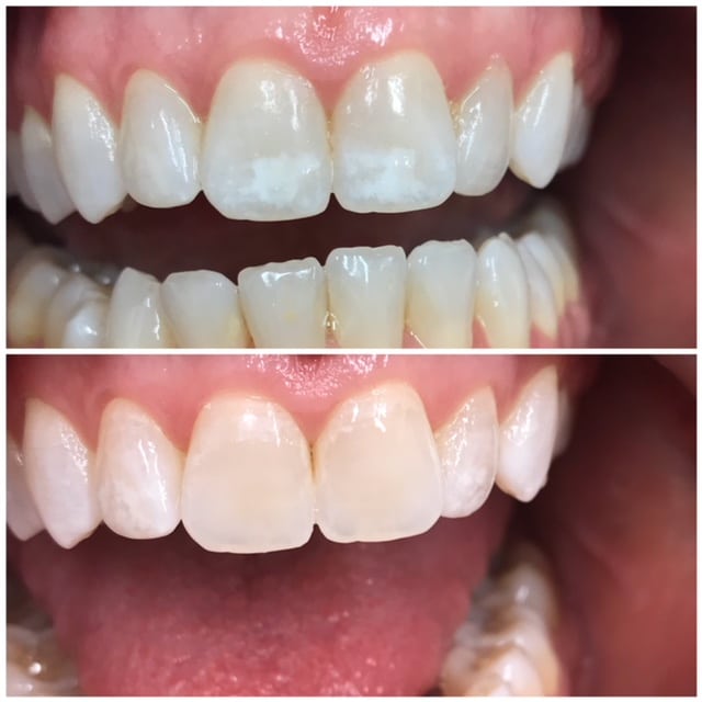 White Spot Removal Treatment Annandale NJ